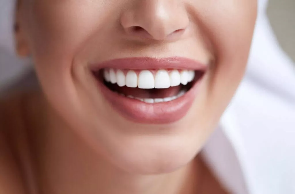 Claves para el diseño de sonrisa con carillas dentales