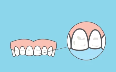 Causas, tipos y tratamiento de manchas dentales