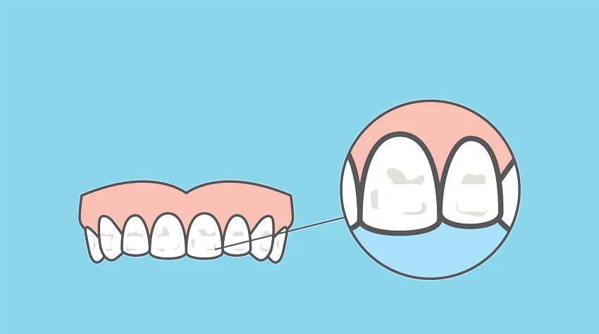 Causas, tipos y tratamiento de manchas dentales