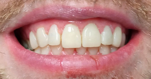 Carillas dentales Alcorcón