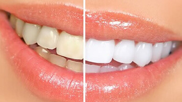 Clínica dental: blanqueamiento dental