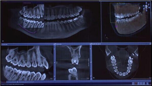 Implantes dentales en Alcorcón