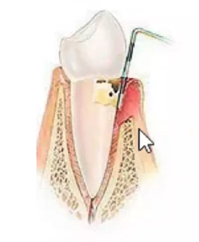 Periodoncia en Alcorcón