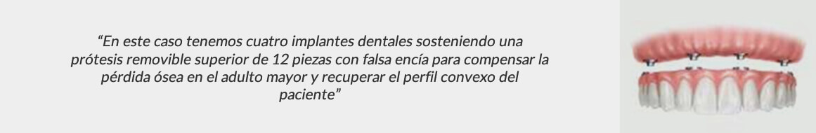 Prótesis dentales en Alcorcón