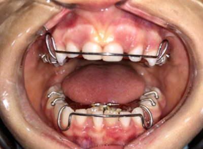 Tratamiento de ortodoncia en Alcorcón